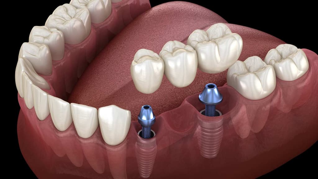How to know whether dental implants are right for me?