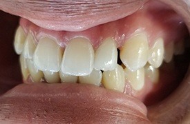 Repaired incisor