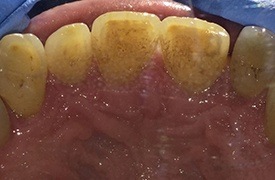 Dark coloring inside the teeth