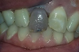 Darkly colored front tooth