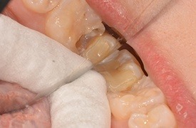 Closeup of damaged teeth before treatment
