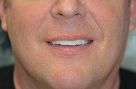 Man's smile after chip tooth repair