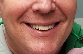 Man's smile with chipped tooth