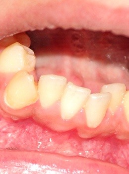 An image of crowded teeth