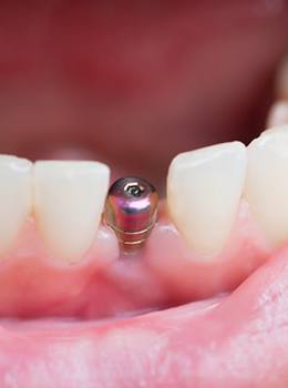 A closeup of a mouth housing a dental implant