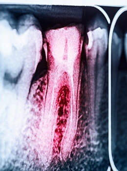 X-ray of root canal treated tooth highlighted red