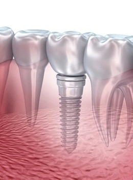 Dental implant in mouth