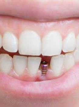 Closeup of smile with implant post visible