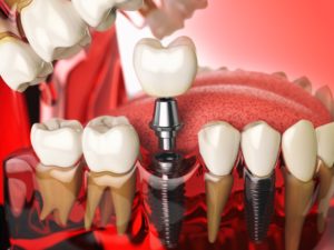 model of dental implant