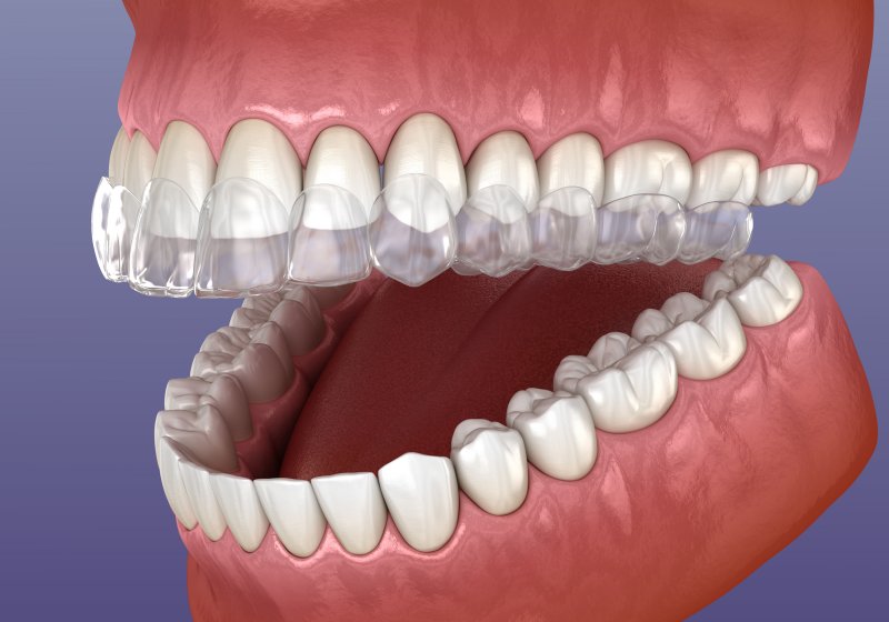 Invisalign on teeth