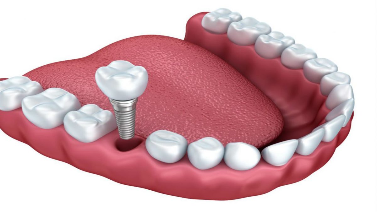 Dental Implants In Virginia Beach