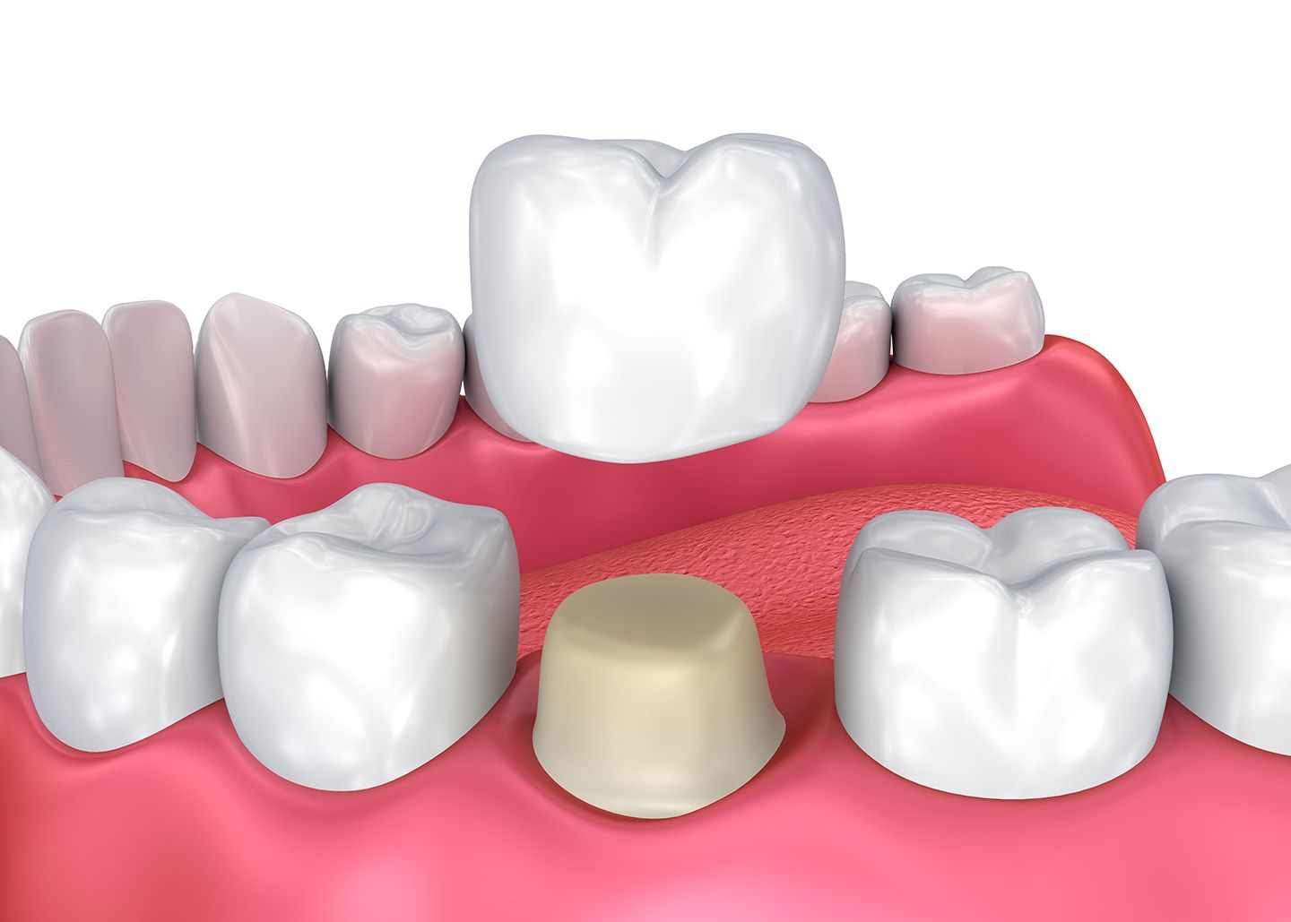 Dental Crowns, Needs, and its cost Lakeshore Dental Blog